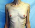 breast_augmentation_photo_thin_401.JPG