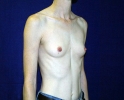breast_augmentation_photo_thin_402.JPG