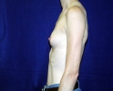 breast_augmentation_photo_thin_405.JPG