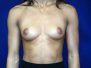 Breast augmentation photos 642*