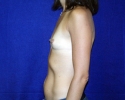 breast_augmentation_photo_torso1.203.JPG