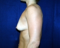 Breast augmentation photos muscle110.JPG