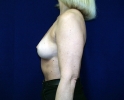 Breast augmentation photos muscle202.JPG
