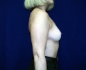 Breast augmentation photos muscle205.JPG