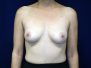 Breast augmentation photos 1049*