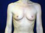 Breast augmentation pictures 1079*