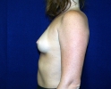 breast_implant_photo_lpfo_202.JPG