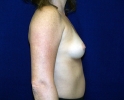 breast_implant_photo_lpfo_204.JPG