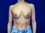 Breast augmentation pictures 1186*