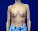 breast_augmentation_photo_thin_206.JPG