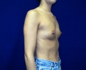 breast_augmentation_photo_thin_209.JPG