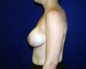 Breast_Augmentation_asd_510.JPG