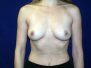Breast augmentation pictures 1327*
