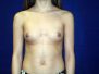 Breast augmentation photos 140*