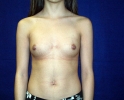 Breast augmentation photos gap_201.JPG