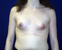 Breast implant pictures dev_201.JPG