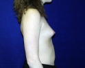 Breast implant pictures dev_202.JPG