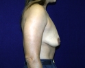 before-breast-augmentation-photo-157.JPG