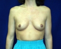 breast_augmentation_photo_upf_301.JPG
