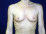 Breast augmentation photos 166*