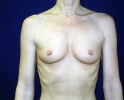 Breast augmentation photos ngap_101.JPG