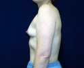 breast_augmentation_photo_asymmetry_602.JPG