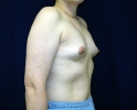 breast_augmentation_photo_asymmetry_604.JPG