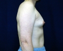 breast_augmentation_photo_asymmetry_605.JPG