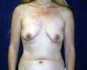 Breast implant pictures shape_601.JPG