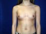 Breast augmentation photos 184*