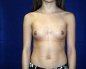 before breast implants photos