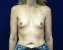 breast_augmentation_photo_vein306.JPG