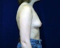 Breast augmentation photos stretch_405.JPG