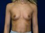 Breast augmentation photos 246*