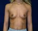 breast_implant_photo_lpfo_401.JPG