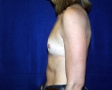 before-picture-breast-augmentation-251.JPG