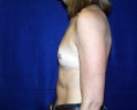 breast_augmentation_photo_thin_505.JPG