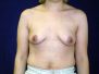 Breast implant pictures 258*
