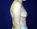 breast_augmentation_photo_shape_703.JPG
