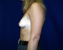 Breast augmentation photos gap_102.JPG