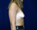 Breast augmentation photos gap_105.JPG
