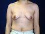 Breast augmentation photos 273*