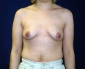 breast_augmentation_photo_outcomes_207.JPG