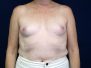 Breast augmentation photos 282*