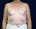Breast augmentation photos heavy_401.JPG