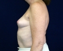 Breast augmentation photos heavy_402.JPG