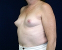 Breast augmentation photos heavy_403.JPG