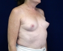 Breast augmentation photos heavy_404.JPG