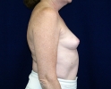 Breast augmentation photos _heavy_405.JPG