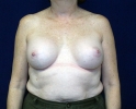 Breast augmentation photos heavy_406.JPG